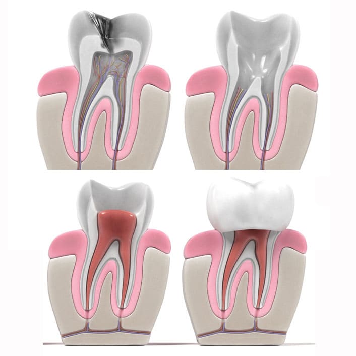 Root Canals Near Me In Kansas City MO Staley Smiles Dental Care